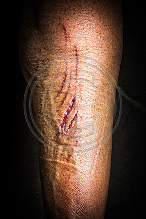 Curt’s injury